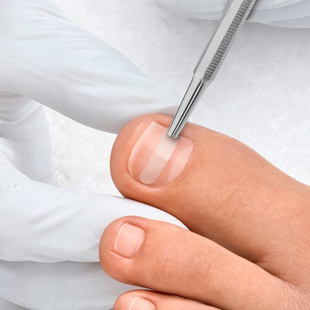 Toenail Correction Plan (3 Visits) at Sole & Structure in Searcy, AR